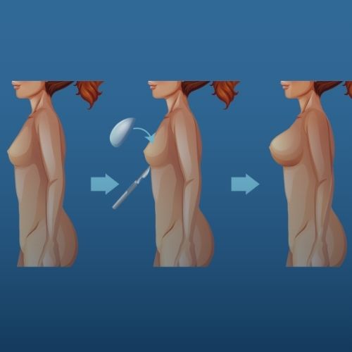 Meme Dikleştirme ve Büyütme Eş Zamanlı